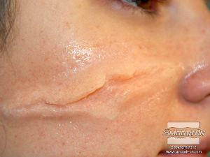 לחיצה להגדלת תמונה האיפור גורם לצלקת להתמזג עם עור המודל.