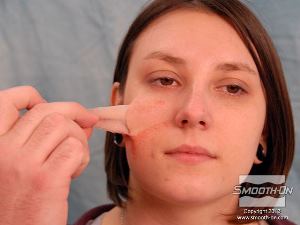 לחיצה להגדלת תמונה הסרת הצלקת פשוטה מאוד. ראשית מקפלים בזהירות את הצלקת מעור המודל.