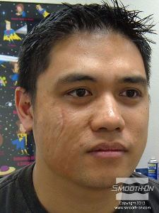 לחיצה להגדלת תמונה צלקת הסיליקון הגמורה הושלמה והיא נראית טבעית ואורגאנית לחלוטין.