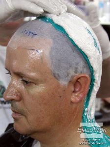 לחיצה להגדלת תמונה לאחר שמורחים את שתי שכבות הסיליקון מניחים תחבושות גבס על אחורי הראש כדי ליצור מעיל תמיכה עבור חצי התבנית האחורי.